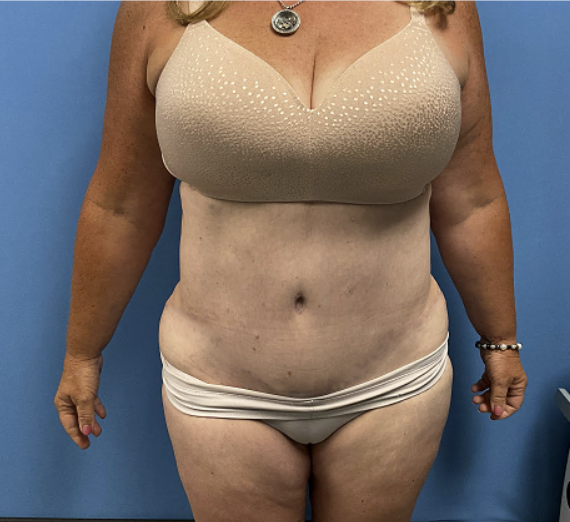 Tummy-Tuck-with-Liposuction--Case-Study-2958 | After Liposuction